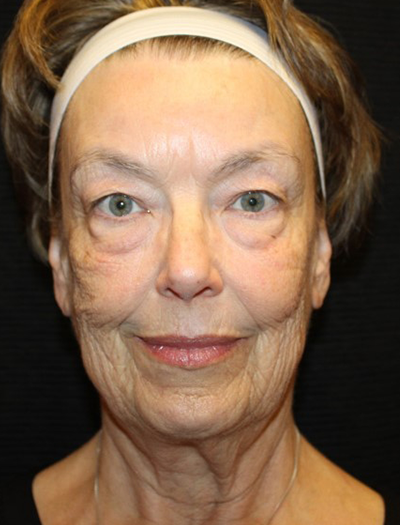 Patient #68494: Chin Augmentation Before Image