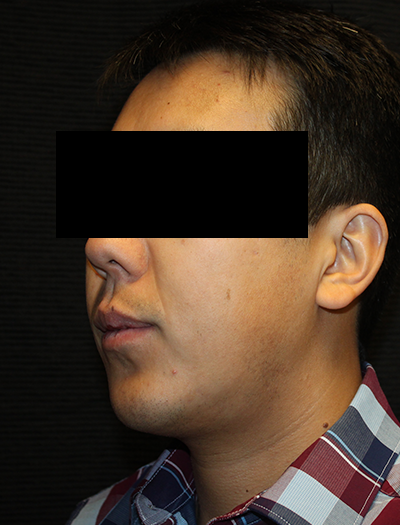 Patient #43730: Chin Augmentation After Image