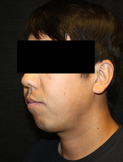 Patient #43730: Chin Augmentation Before Image