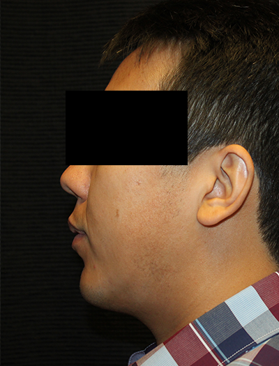 Patient #43730: Chin Augmentation After Image
