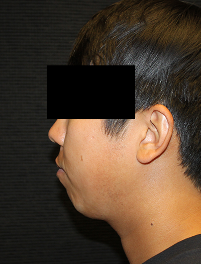 Patient #43730: Chin Augmentation Before Image