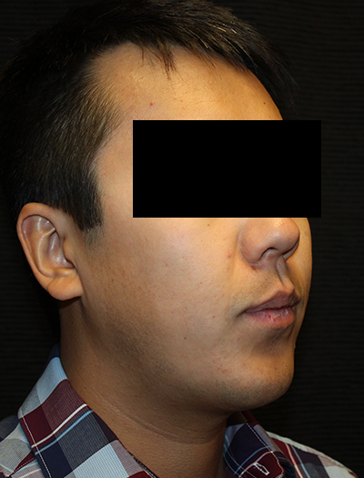 Patient #43730: Chin Augmentation After Image