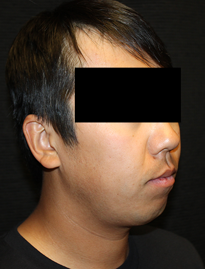 Patient #43730: Chin Augmentation Before Image