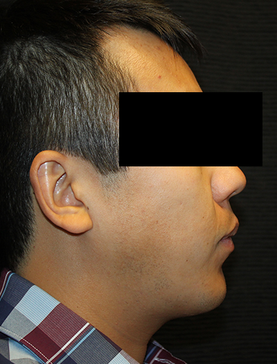 Patient #43730: Chin Augmentation After Image