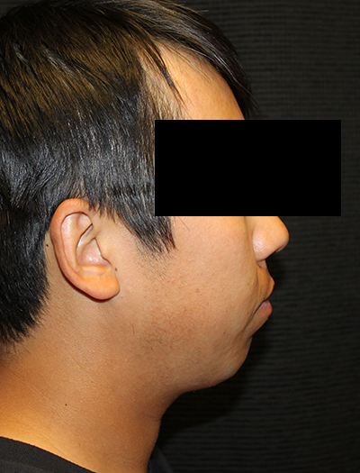 Patient #43730: Chin Augmentation Before Image