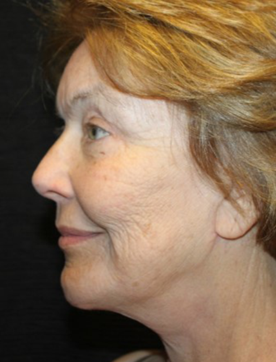 Patient #68494: Chin Augmentation After Image