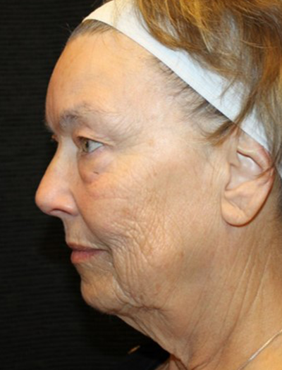 Patient #68494: Chin Augmentation Before Image