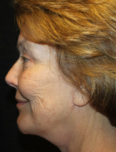 Patient #68494: Chin Augmentation After Image