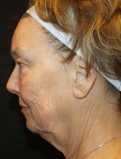 Patient #68494: Chin Augmentation Before Image