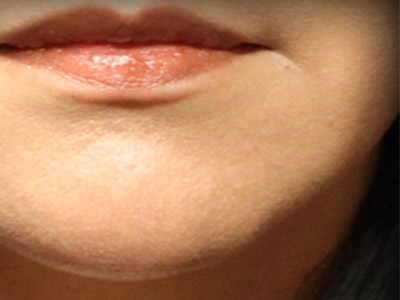 Patient #96564: Juvederm Ultra Plus After Image