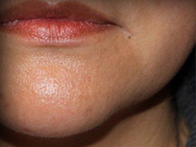 Patient #96564: Juvederm Ultra Plus Before Image