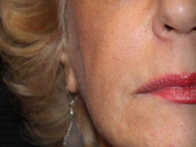 Patient #32700: Juvéderm Ultra Plus After Image