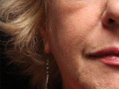 Patient #32700: Juvéderm Ultra Plus Before Image