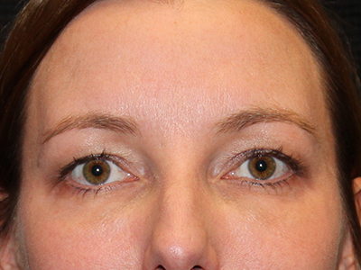 Patient #28224: Restylane After Image