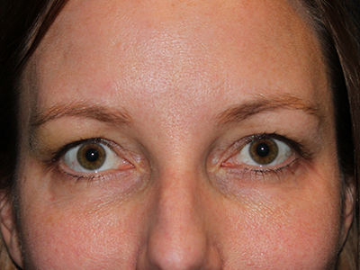 Patient #28224: Restylane Before Image