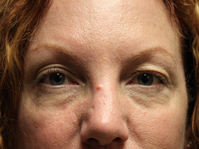 Patient #21973: Restylane Before Image