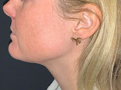 Patient #78961: Kybella After Image