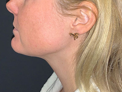 Patient #78961: Kybella After Image