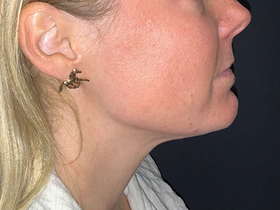 Patient #78961: Kybella After Image