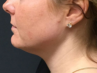 Patient #78961: Kybella Before Image