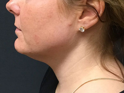 Patient #78961: Kybella Before Image