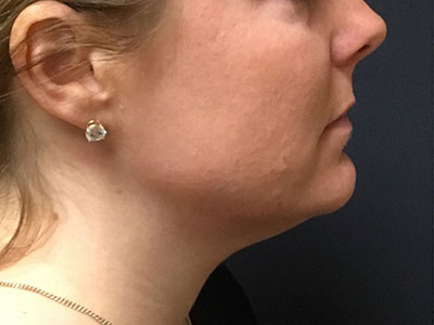 Patient #78961: Kybella Before Image