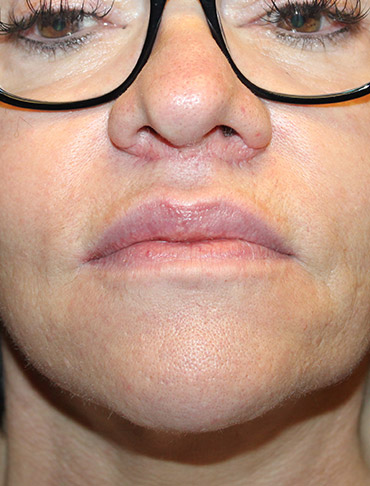 Patient #63951: Lip Lift After Image