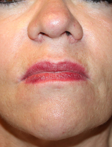 Patient #63951: Lip Lift Before Image