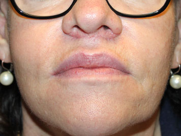 Patient #81116: Lip Lift After Image