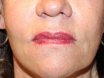 Patient #81116: Lip Lift Before Image