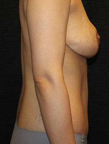 Patient #44548: Mommy Makeover, Breast Reduction After Image