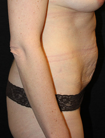 Patient #37599: Mommy Makeover Before Image