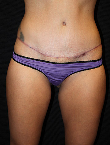 Patient #35021: Mommy Makeover After Image