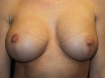 Patient #94415: Nipple Inversion Before Image