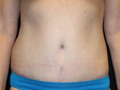 Patient #36743: Tummy Tuck After Image