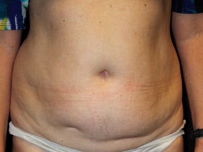 Patient #36743: Tummy Tuck Before Image