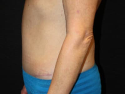 Patient #36743: Tummy Tuck After Image