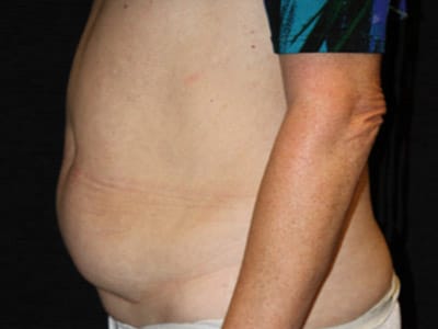 Patient #36743: Tummy Tuck Before Image