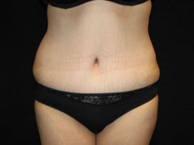 Patient #61908: Tummy Tuck After Image
