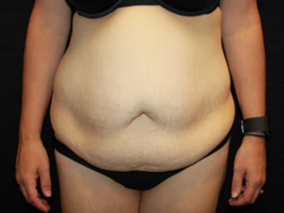 Patient #61908: Tummy Tuck Before Image