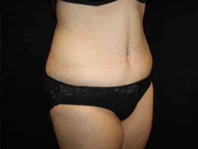 Patient #61908: Tummy Tuck After Image