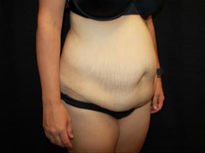 Patient #61908: Tummy Tuck Before Image