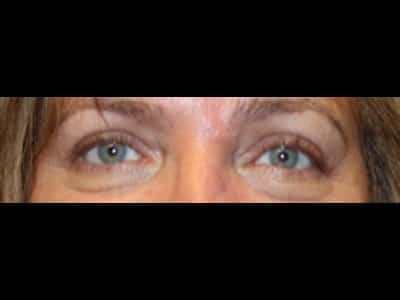 Patient #73626: Bilateral Upper Blepharoplasty Before Image
