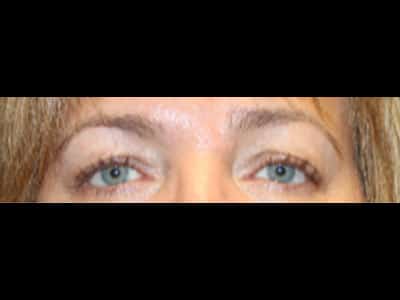 Patient #73626: Bilateral Upper Blepharoplasty After Image