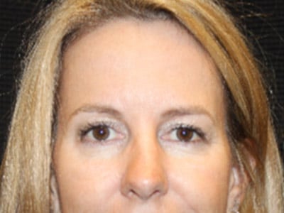 Patient #33781: Upper Blepharoplasty & Brow Lift After Image