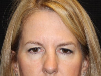 Patient #33781: Upper Blepharoplasty & Brow Lift Before Image
