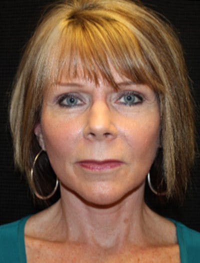 Patient #68716: In-Office Facelift & Fat Transfer After Image