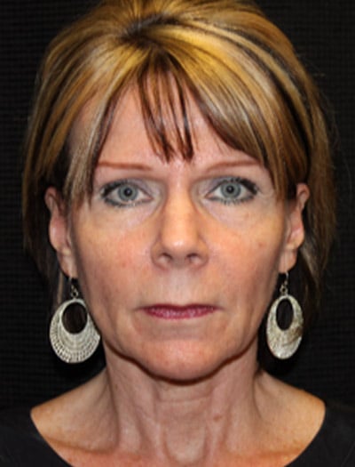 Patient #68716: In-Office Facelift & Fat Transfer Before Image