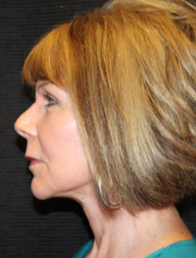 Patient #68716: In-Office Facelift & Fat Transfer After Image