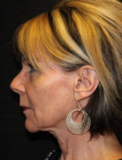 Patient #68716: In-Office Facelift & Fat Transfer Before Image